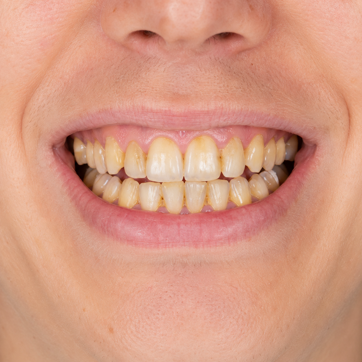 Teeth before dental treatment